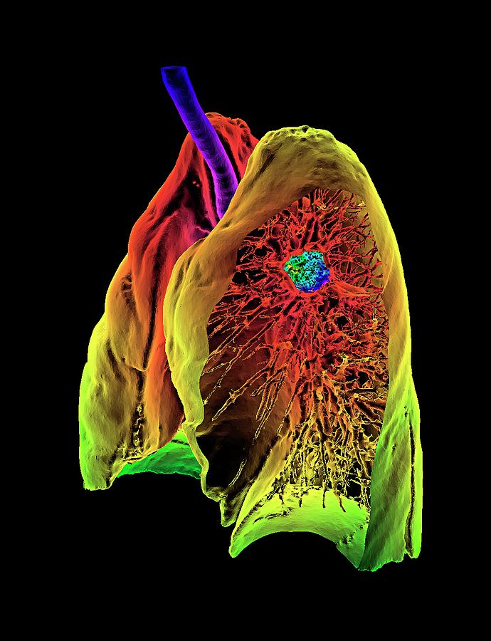 Lung Cancer Photograph By K H Fung Science Photo Library Fine Art America