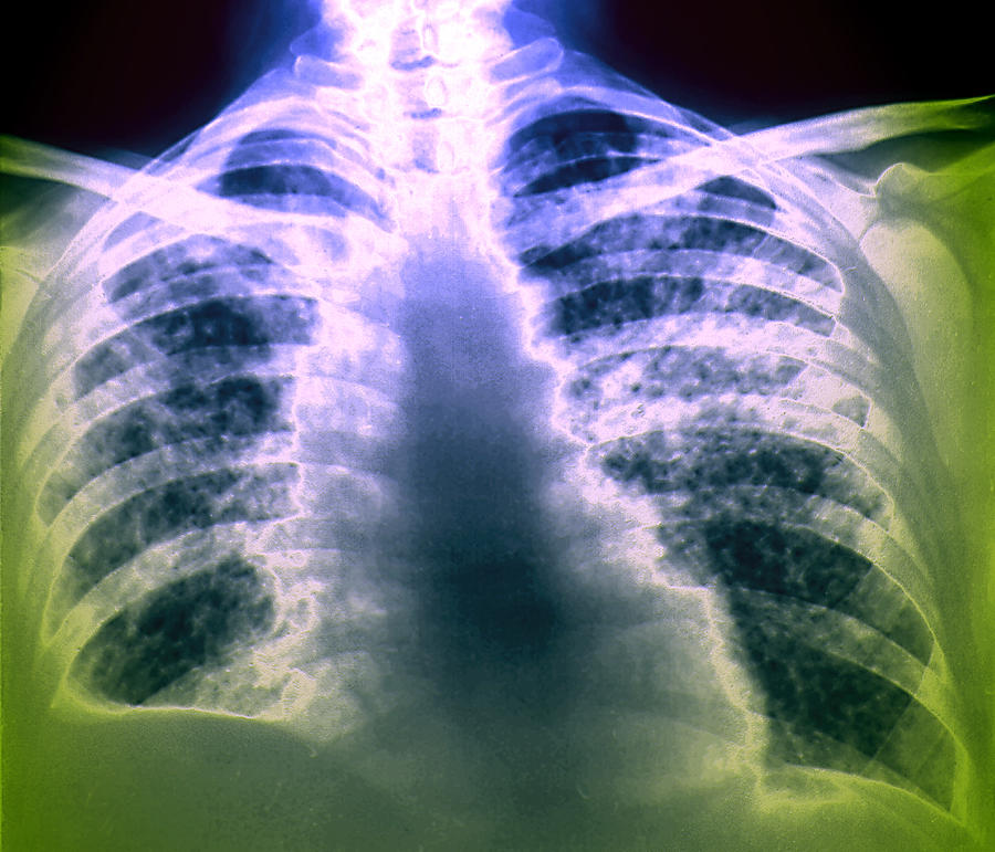 Lung Cancer Photograph by Zephyr/science Photo Library - Fine Art America