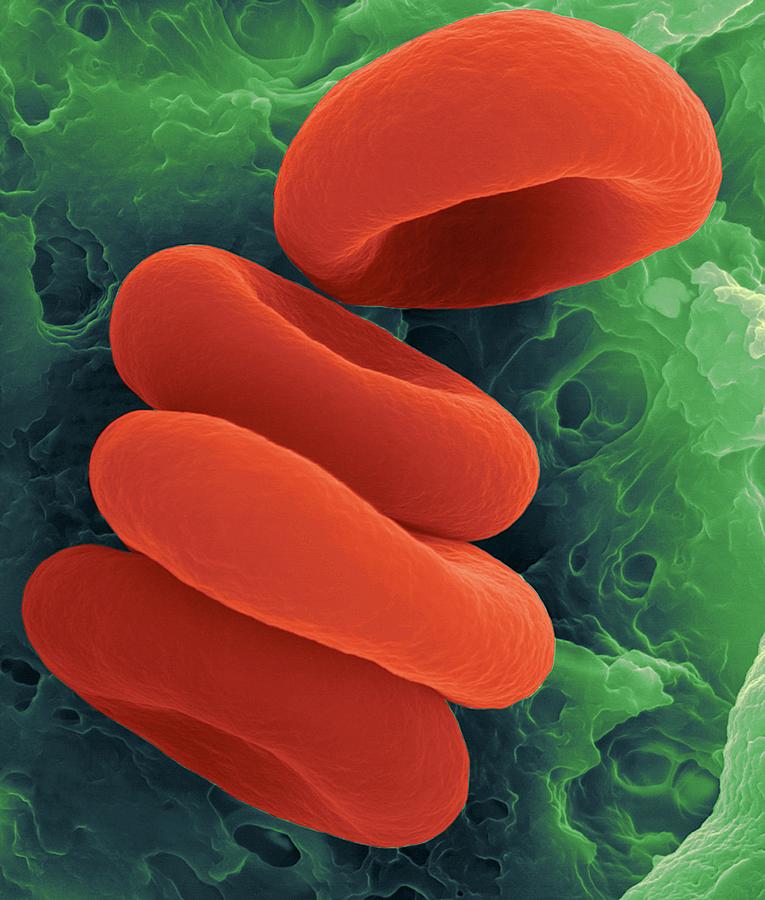 Red Blood Cells In The Rouleau Formation #6 Photograph by Dennis Kunkel Microscopy/science Photo Library