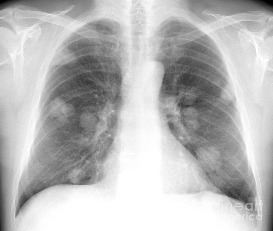 Secondary Lung Cancers, X-ray Photograph by Du Cane Medical Imaging Ltd ...