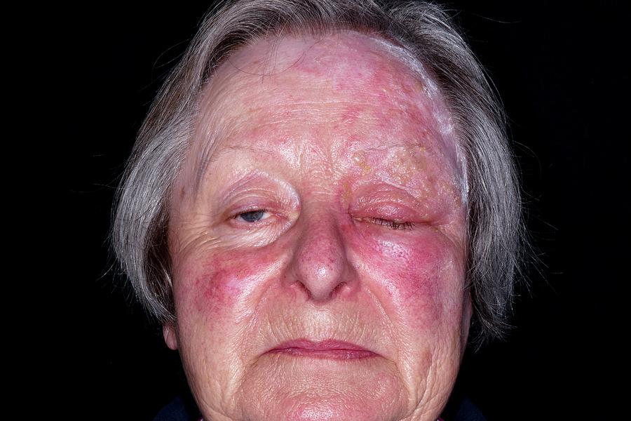Shingles Rash On The Face Photograph By Dr P Marazzis Vrogue Co