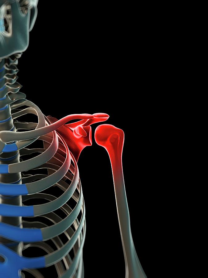 Shoulder Pain #6 Photograph by Sciepro/science Photo Library