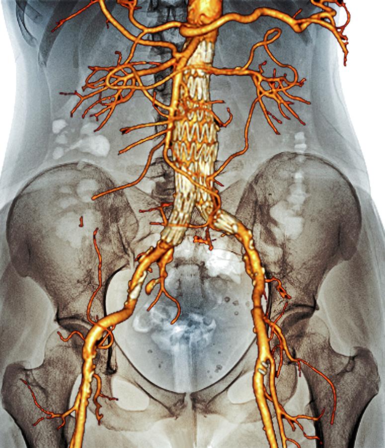 Stent In Aortic Aneurysm Photograph By Zephyrscience Photo Library Pixels 3423