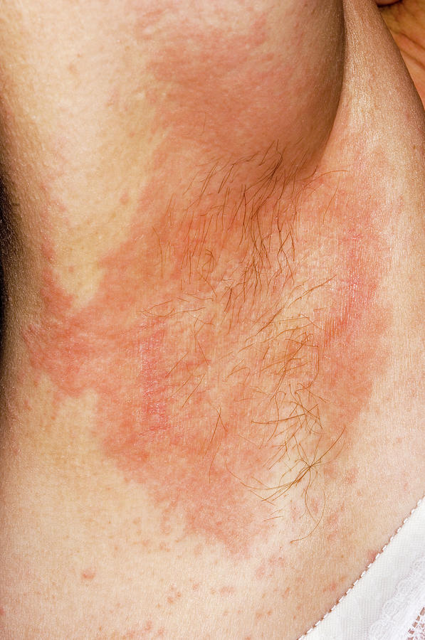 Urticaria Rash Photograph By Dr P Marazziscience Photo Library