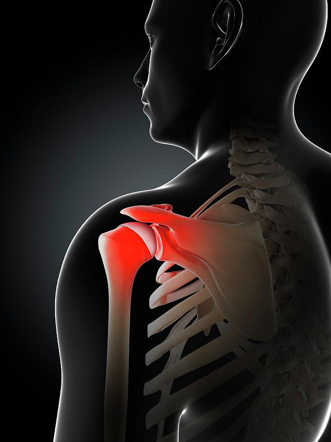 Shoulder Pain #61 Photograph by Sciepro/science Photo Library