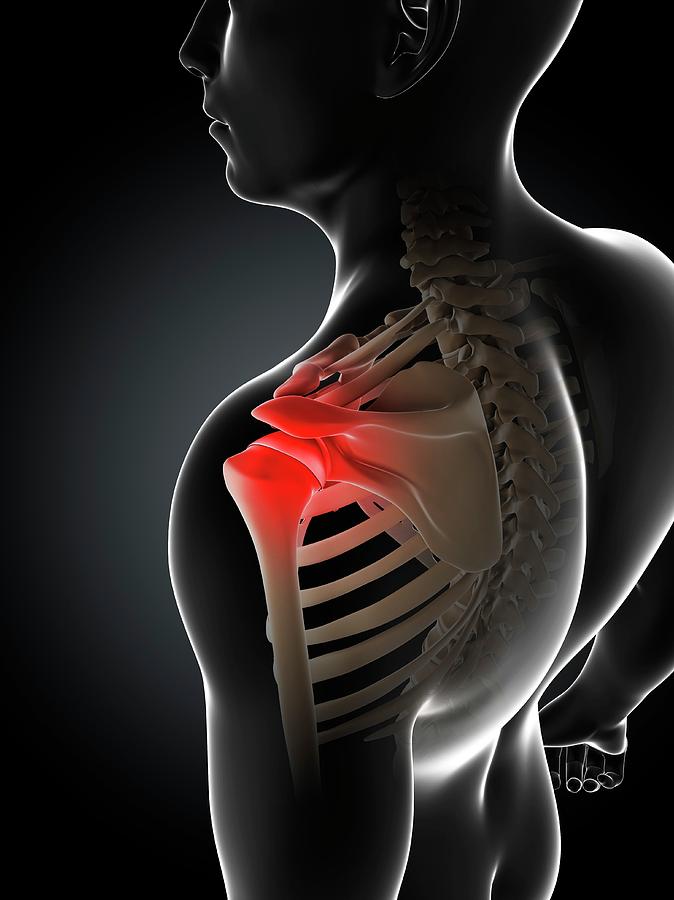Shoulder Pain #69 Photograph by Sciepro/science Photo Library