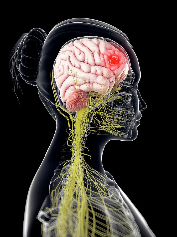Brain Cancer #7 Photograph by Sciepro/science Photo Library