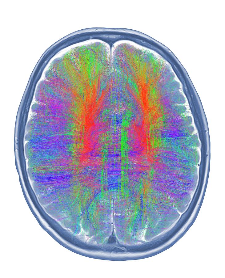 Brain Mri And White Matter Fibres #7 Photograph by Alfred Pasieka/science Photo Library