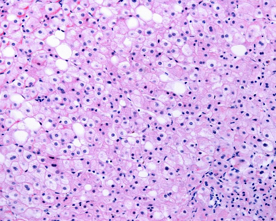 Abnormal Photograph - Fatty Liver #7 by Jose Calvo / Science Photo Library