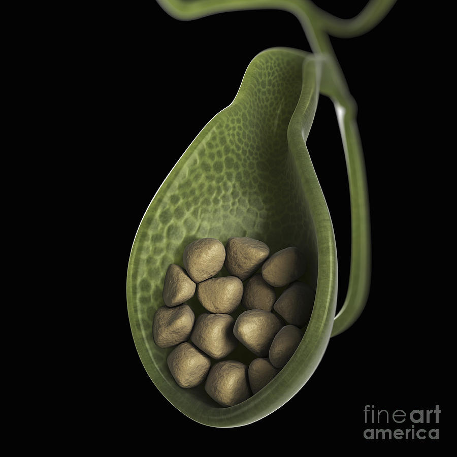 Gallstones Photograph by Science Picture Co - Fine Art America