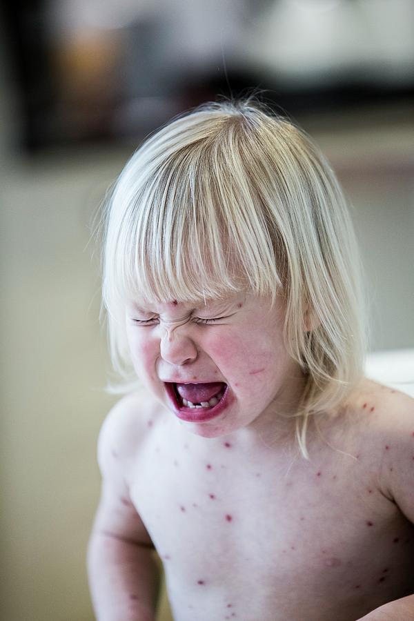 Girl With Chickenpox Photograph By Samuel Ashfieldscience Photo