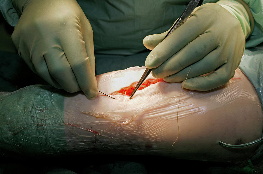 Knee Replacement Surgery #7 Photograph by Antonia Reeve/science Photo Library