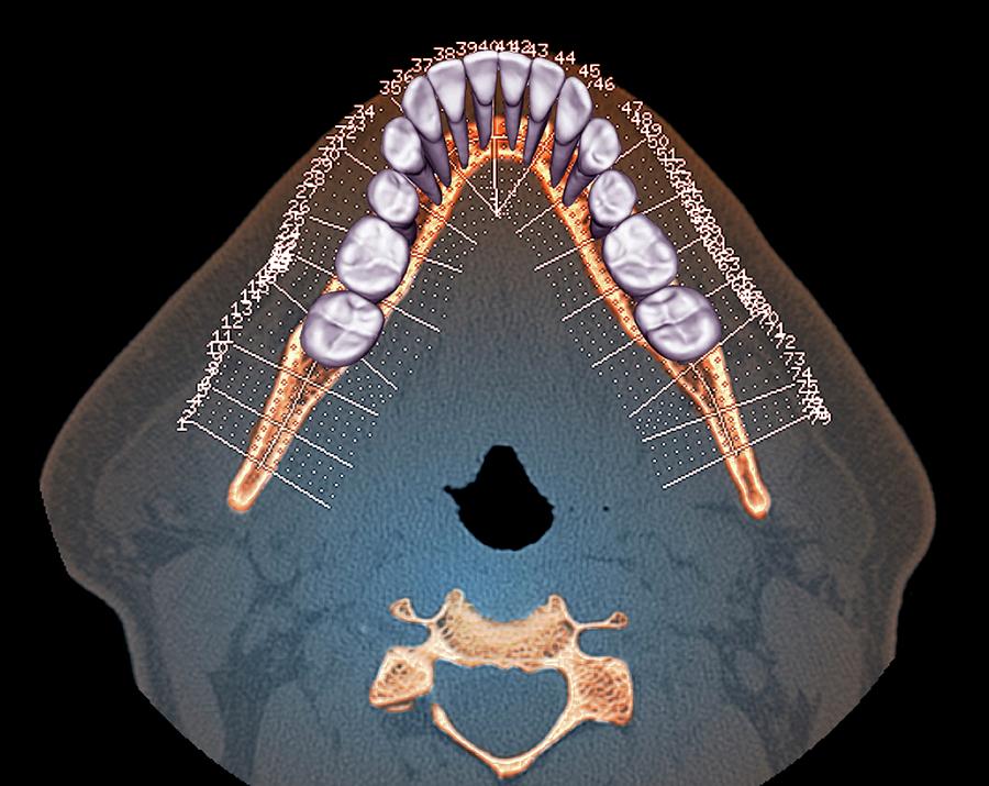 Normal Teeth #7 Photograph by Science Photo Library - Pixels