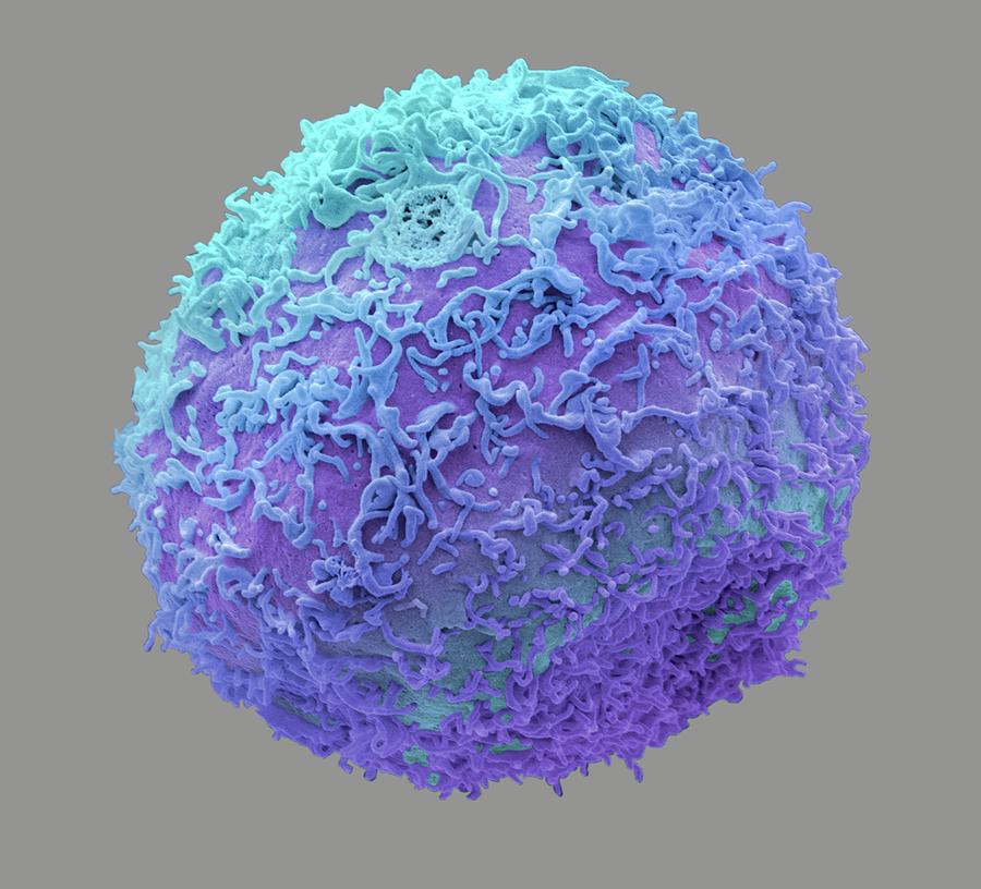 Abnormal Photograph - Prostate Cancer Cell #7 by Steve Gschmeissner