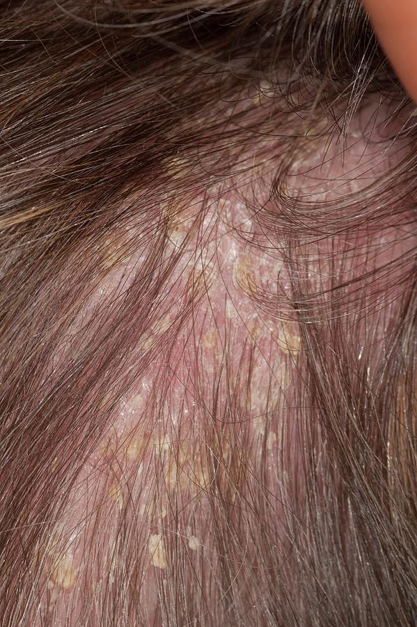 Psoriasis On The Scalp Photograph by Dr P. Marazzi/science Photo Library