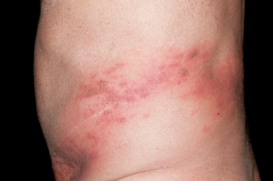 Shingles Rash On The Back Photograph by Dr P. Marazzi/science Photo Library