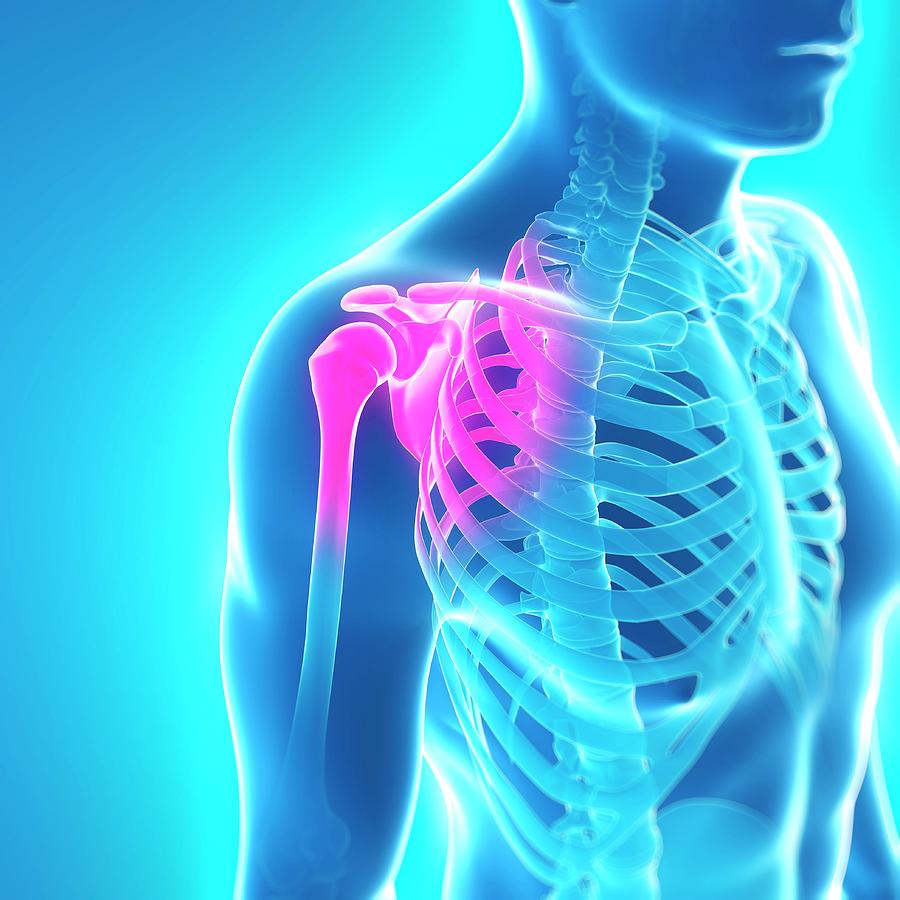 Shoulder Pain #7 Photograph by Sciepro/science Photo Library