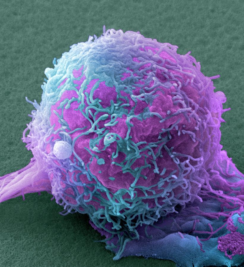 Skin Cancer Cell Photograph By Steve Gschmeissner Pixels