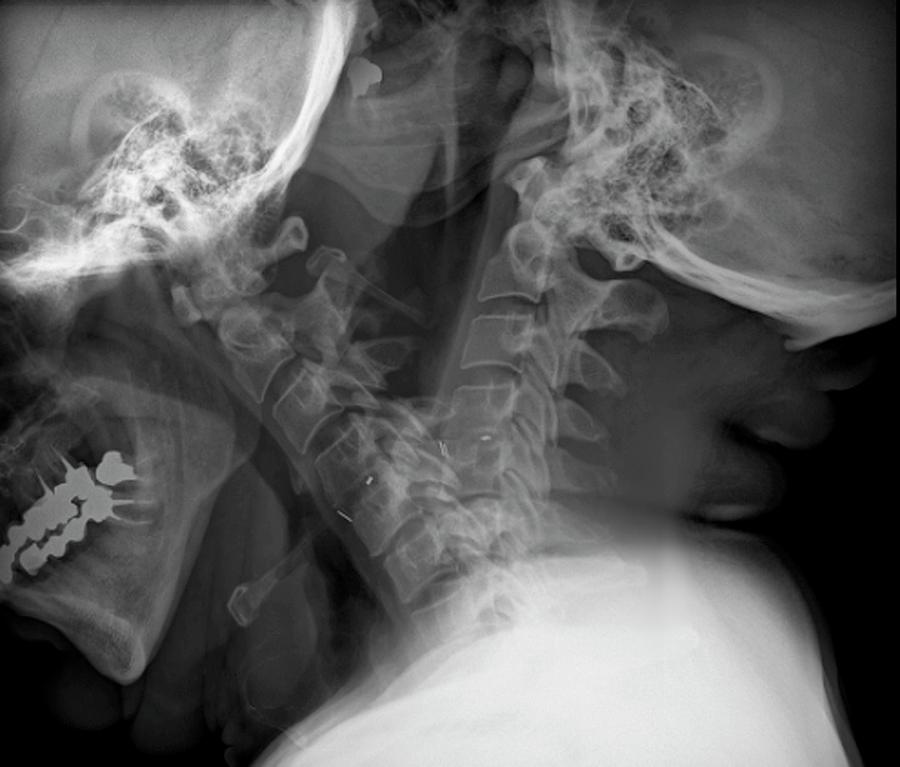 Spine Fixation Photograph by Zephyr/science Photo Library - Fine Art ...