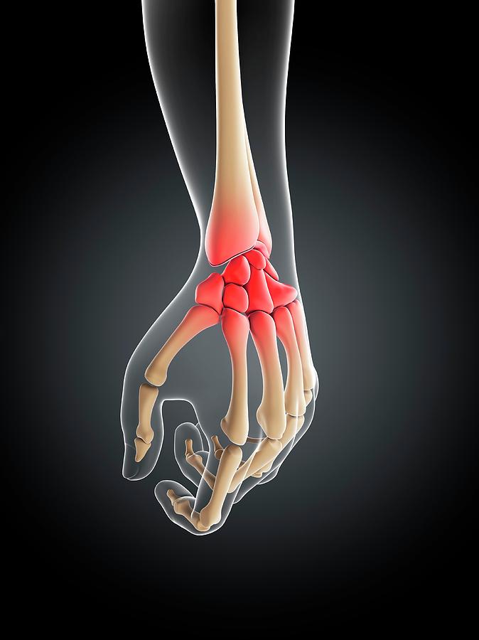 Wrist Pain #7 Photograph by Sciepro/science Photo Library