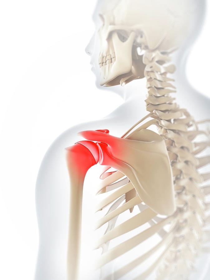 Shoulder Pain Photograph by Sciepro/science Photo Library - Fine Art ...