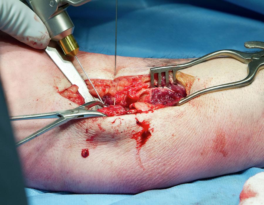 Arm Fracture Surgery #8 Photograph by Mark Thomas/science Photo Library