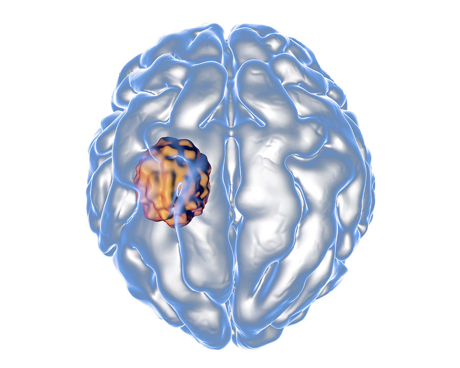 Brain 8 1. Аспергиллез головного мозга. Шар мицетома. Гриб в мозгу арт.