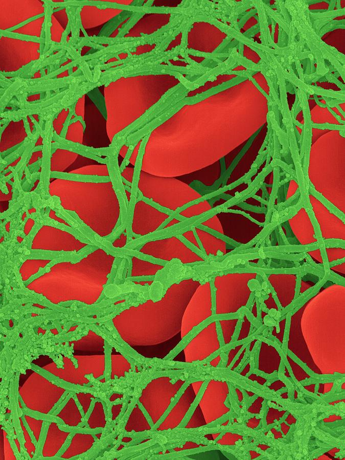 Medical Photograph - Blood Clot by Dennis Kunkel Microscopy/science Photo Library Medical Photograph - Blood Clot by Dennis Kunkel Microscopy/science Photo Library