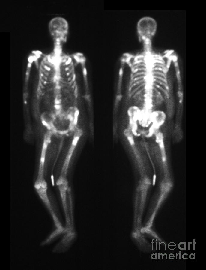 Bone Scan Showing Multiple Metastases #8 Photograph by Scott Camazine