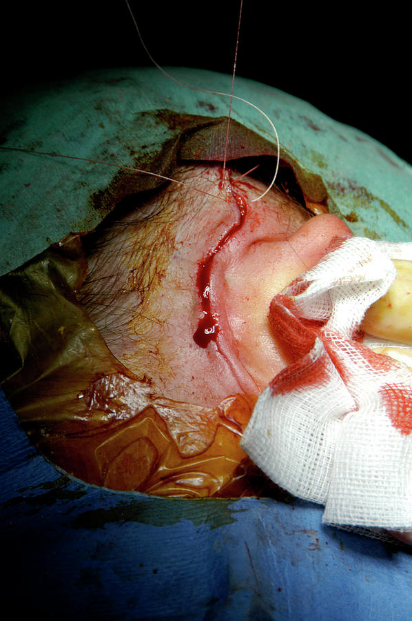 Paris Photograph - Cochlear Implant Surgery #8 by Aj Photo/science Photo Library