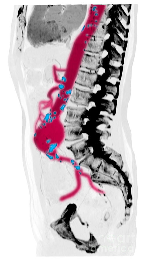 Ct Scan Of Abdominal Aortic Aneurysm #8 Photograph by Scott Camazine