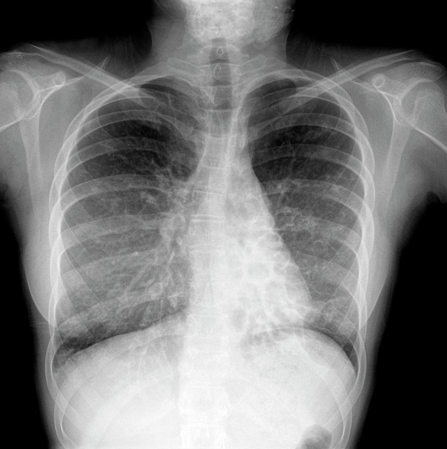 Cystic Fibrosis #8 Photograph by Photostock-israel/science Photo Library