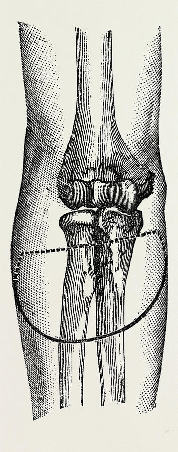 Disarticulation, Medical Equipment, Surgical Instrument #8 Drawing by ...