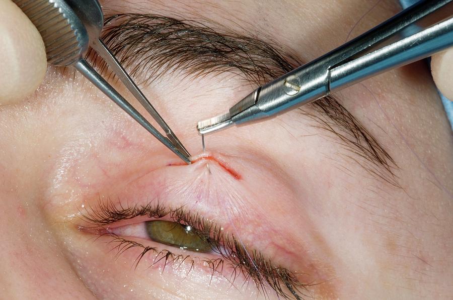 Eyelid Surgery Photograph By Dr P Marazziscience Photo Library