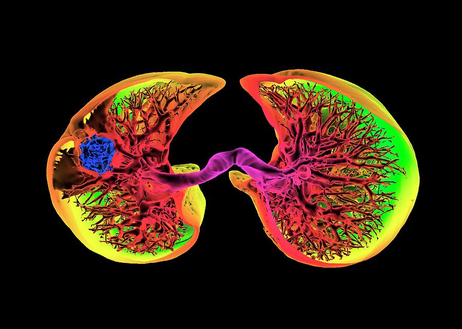 Lung Cancer Photograph - Lung Cancer #8 by K H Fung/science Photo Library