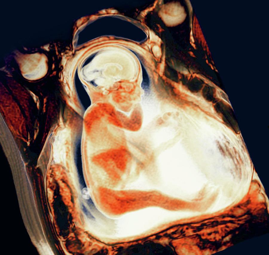 8 Month Foetus Photograph by Thierry Berrod, Mona Lisa Production/ Science Photo Library