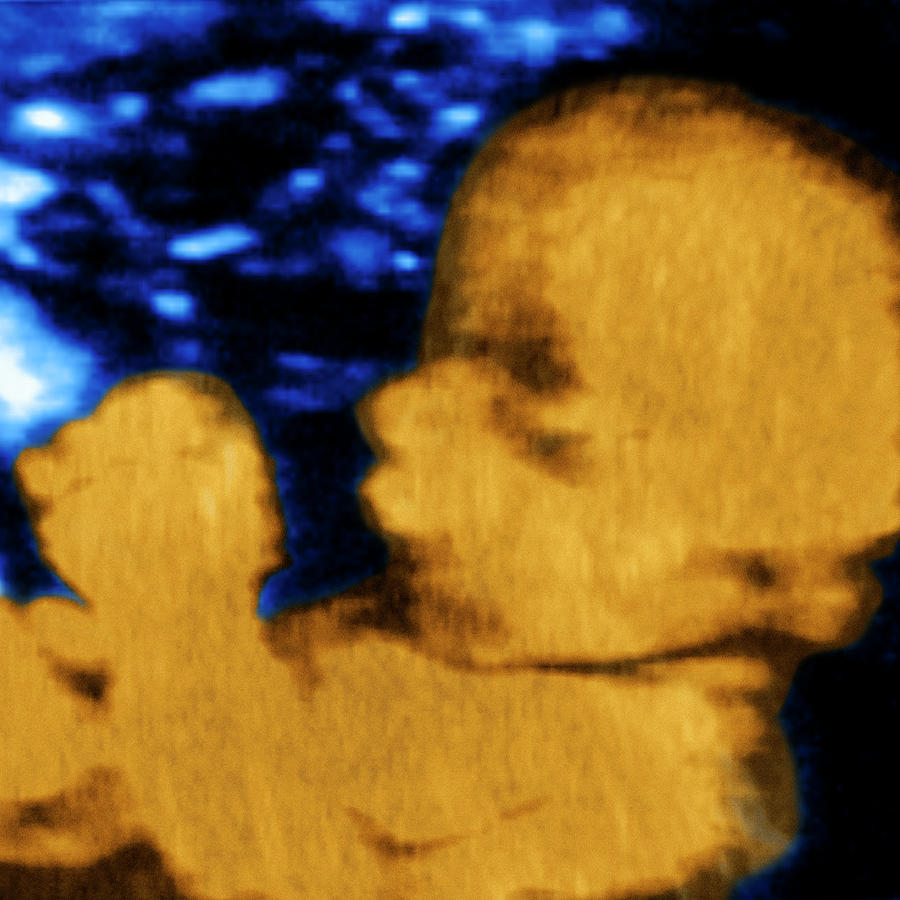 8 Month Old Foetus Photograph by Aj Photo/science Photo Library