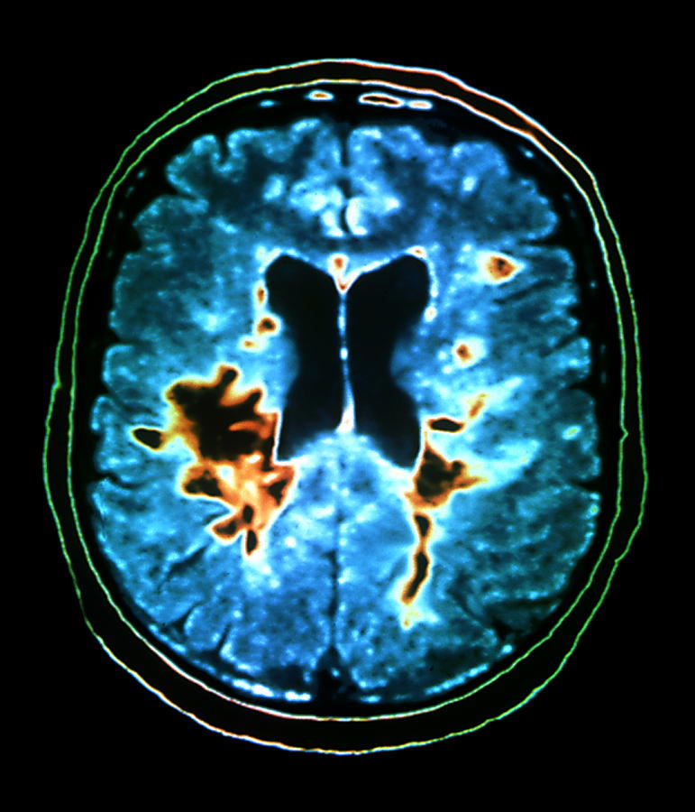 Multiple Sclerosis #8 Photograph by Zephyr/science Photo Library