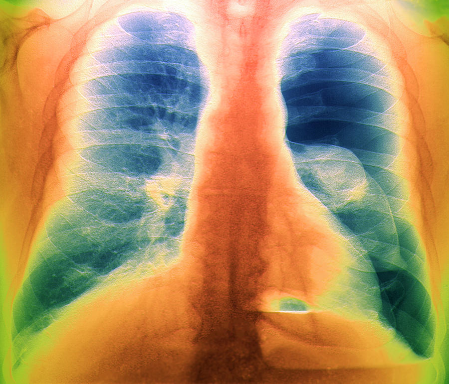 Pneumothorax Photograph by Zephyr/science Photo Library