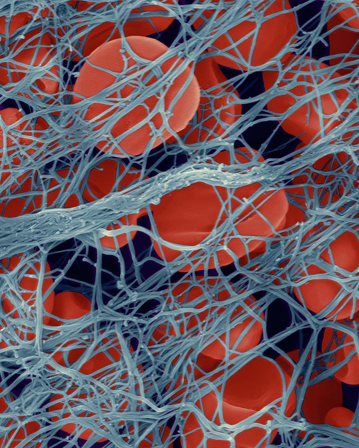 Blood Photograph - Red Blood Cells In A Blood Clot by Dennis Kunkel Microscopy/science Photo Library Blood Photograph - Red Blood Cells In A Blood Clot by Dennis Kunkel Microscopy/science Photo Library