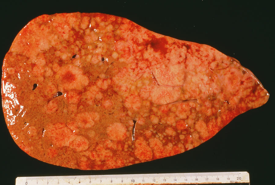 secondary-liver-cancer-photograph-by-cnri-science-photo-library