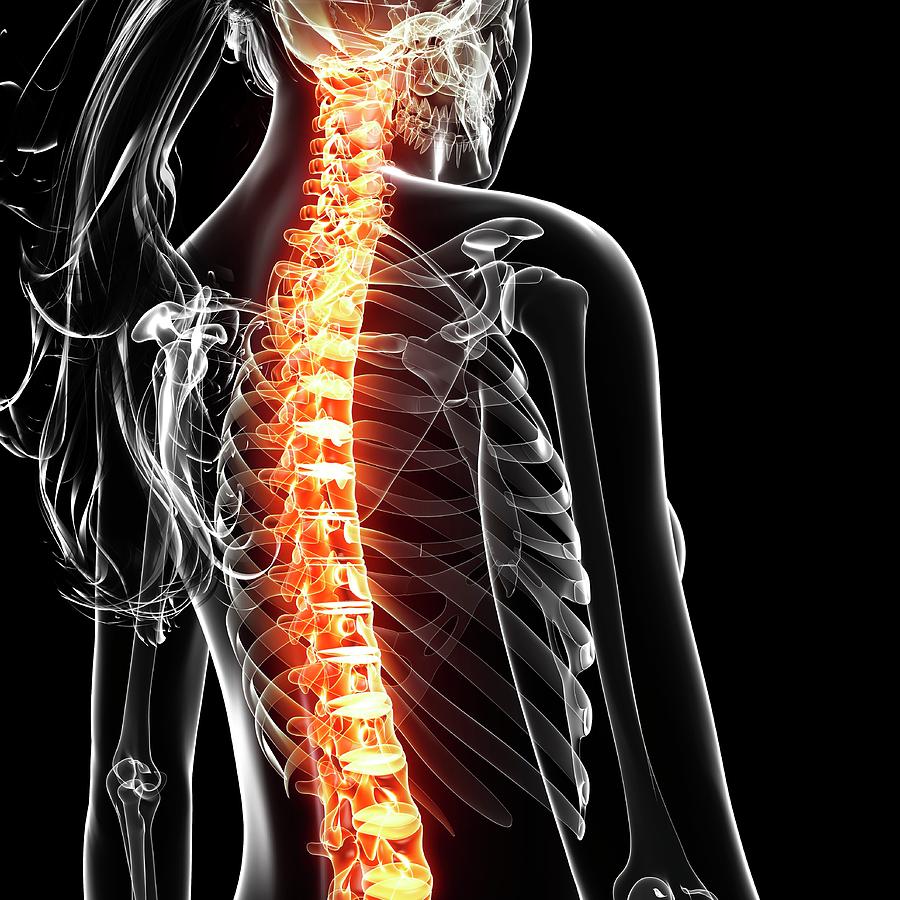 Spine Pain Photograph by Pixologicstudio/science Photo Library - Fine ...