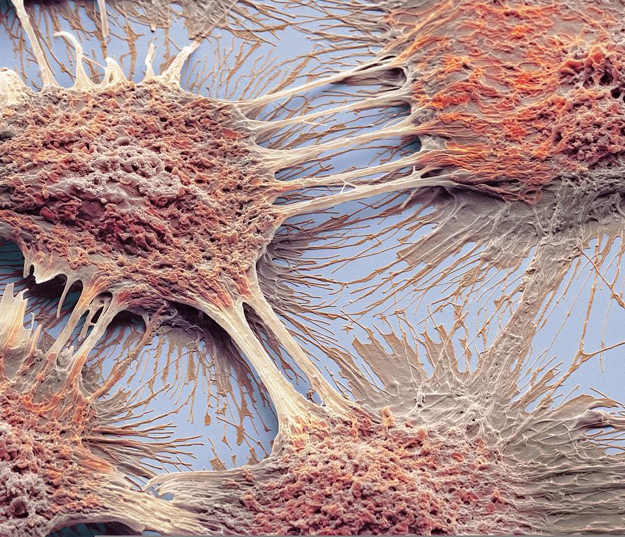 Vaginal cancer cells