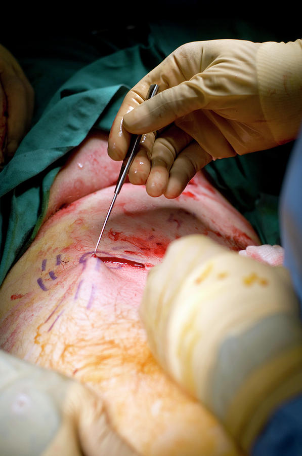 Varicose Vein Surgery Photograph by Jim Varney/science Photo Library