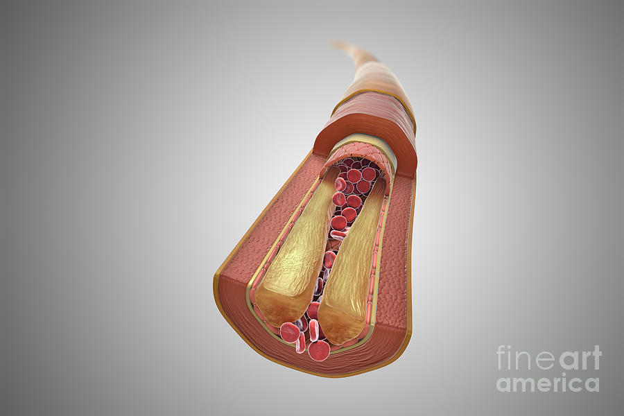 Atherosclerosis #9 Photograph by Science Picture Co