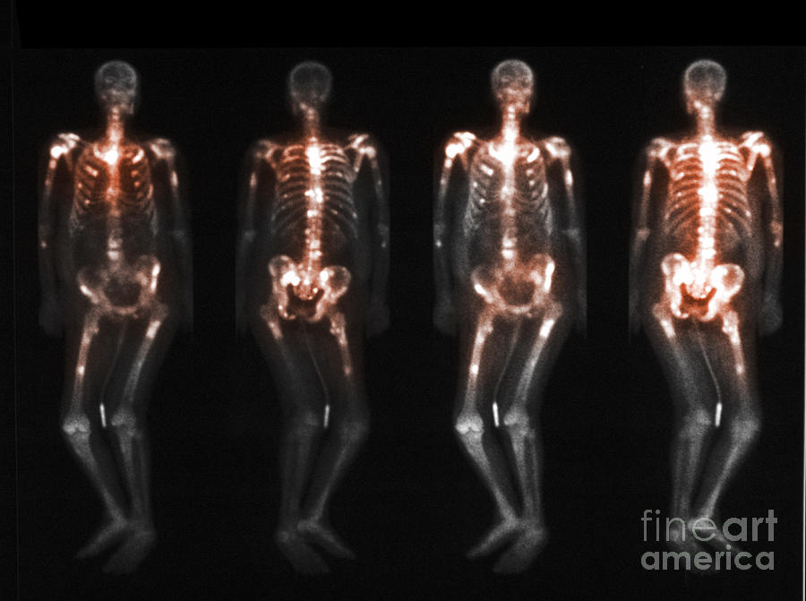 Bone Scan Showing Multiple Metastases #9 Photograph by Scott Camazine