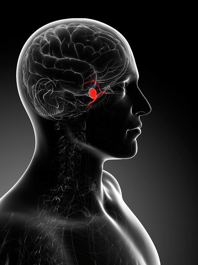 Brain Aneurysm Photograph by Sciepro/science Photo Library - Fine Art ...