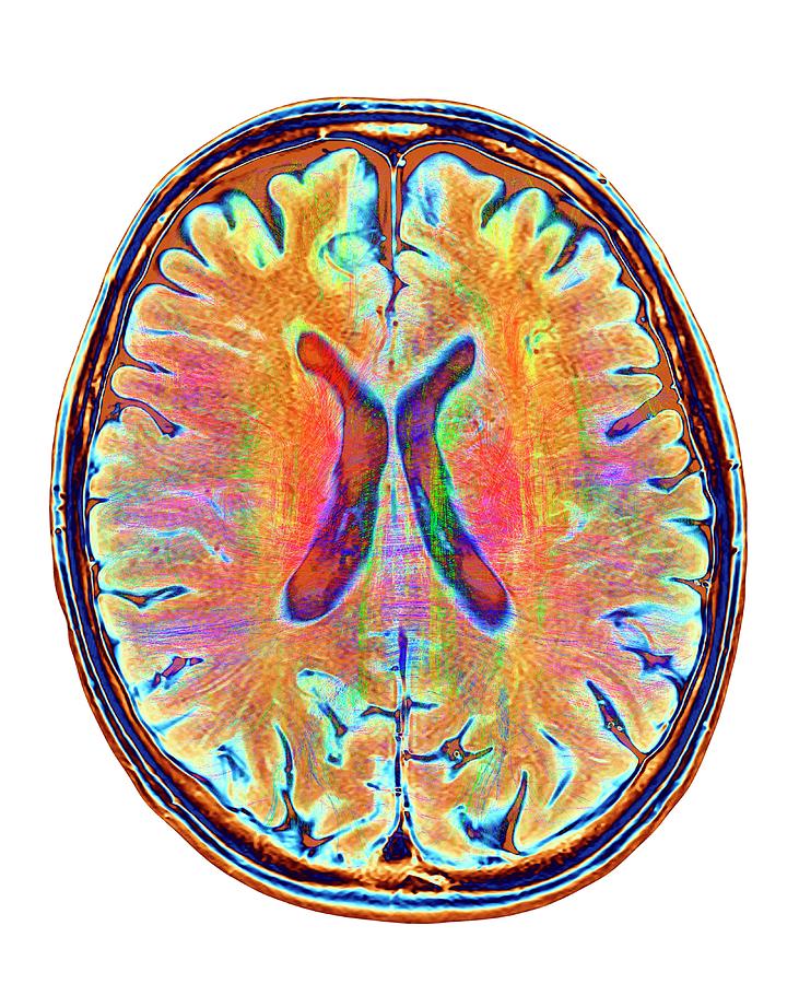 Brain Mri And White Matter Fibres #9 Photograph by Alfred Pasieka/science Photo Library