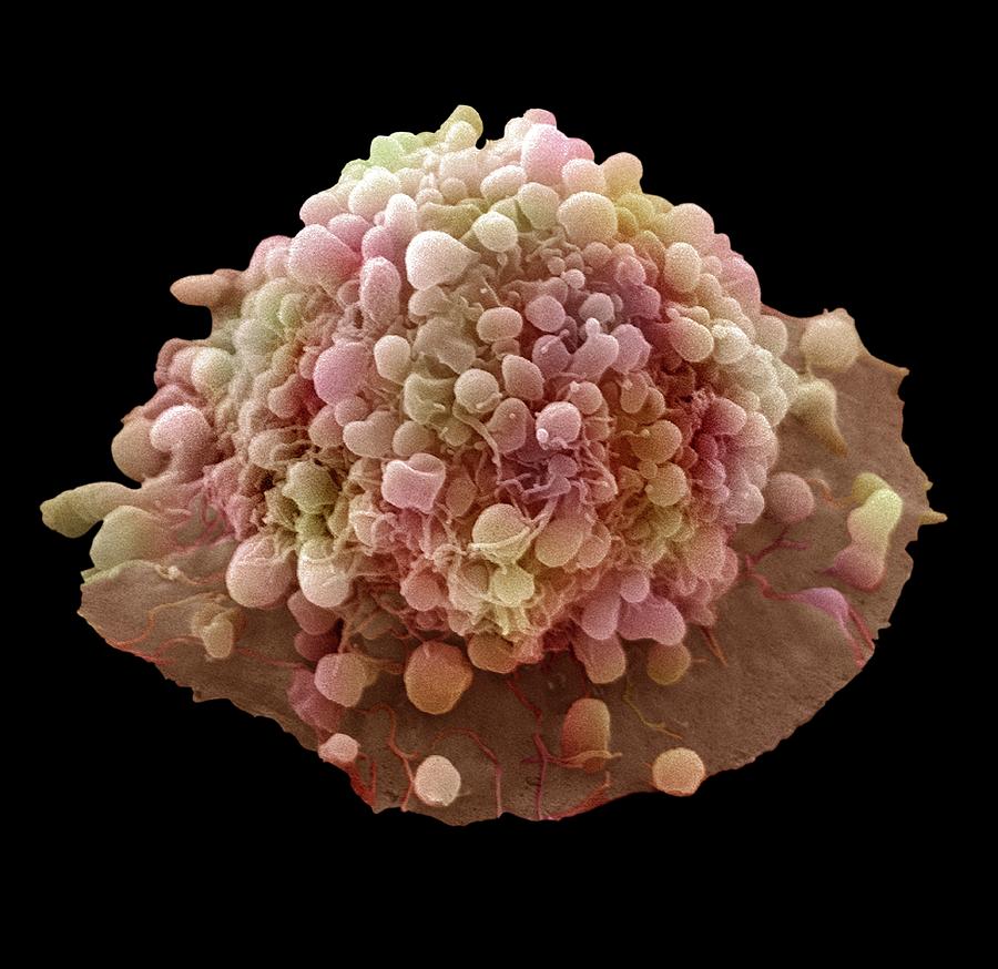 Cervical Cancer Cell Photograph By Steve Gschmeissner Fine Art America