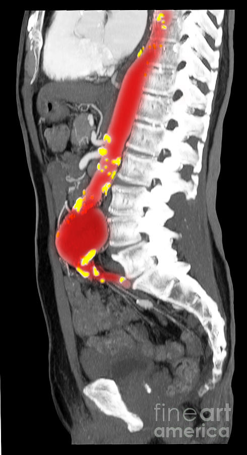 Ct Scan Of Abdominal Aortic Aneurysm #9 Photograph by Scott Camazine